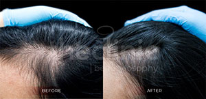 Hair PRP